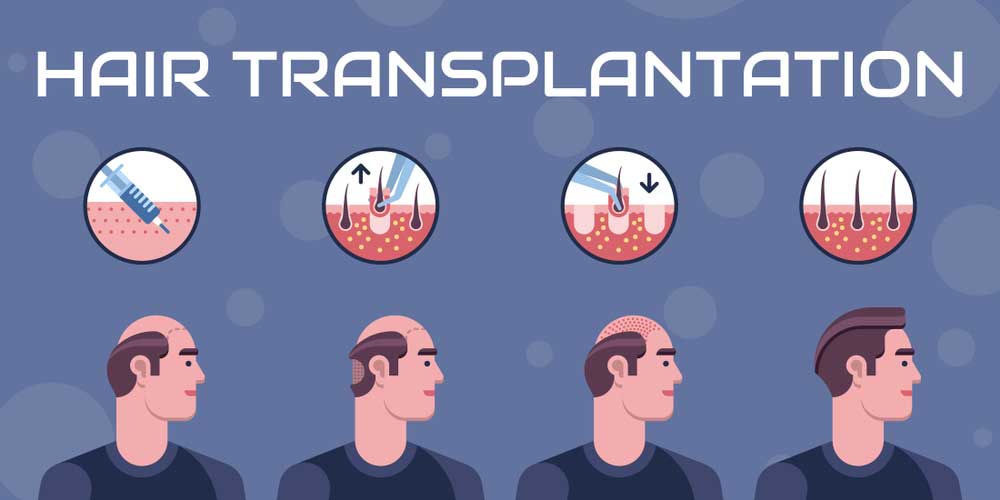 ALL YOU NEED TO KNOW ABOUT FUE HAIR TRANSPLANT
